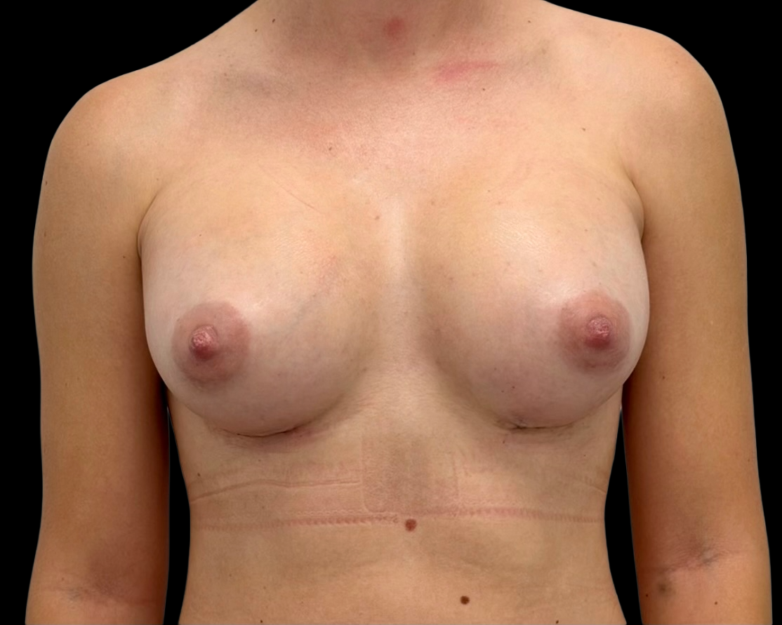 Breast Augmentation after treatment
