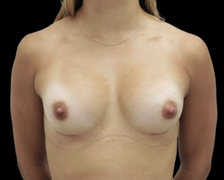 Breast Augmentation after treatment