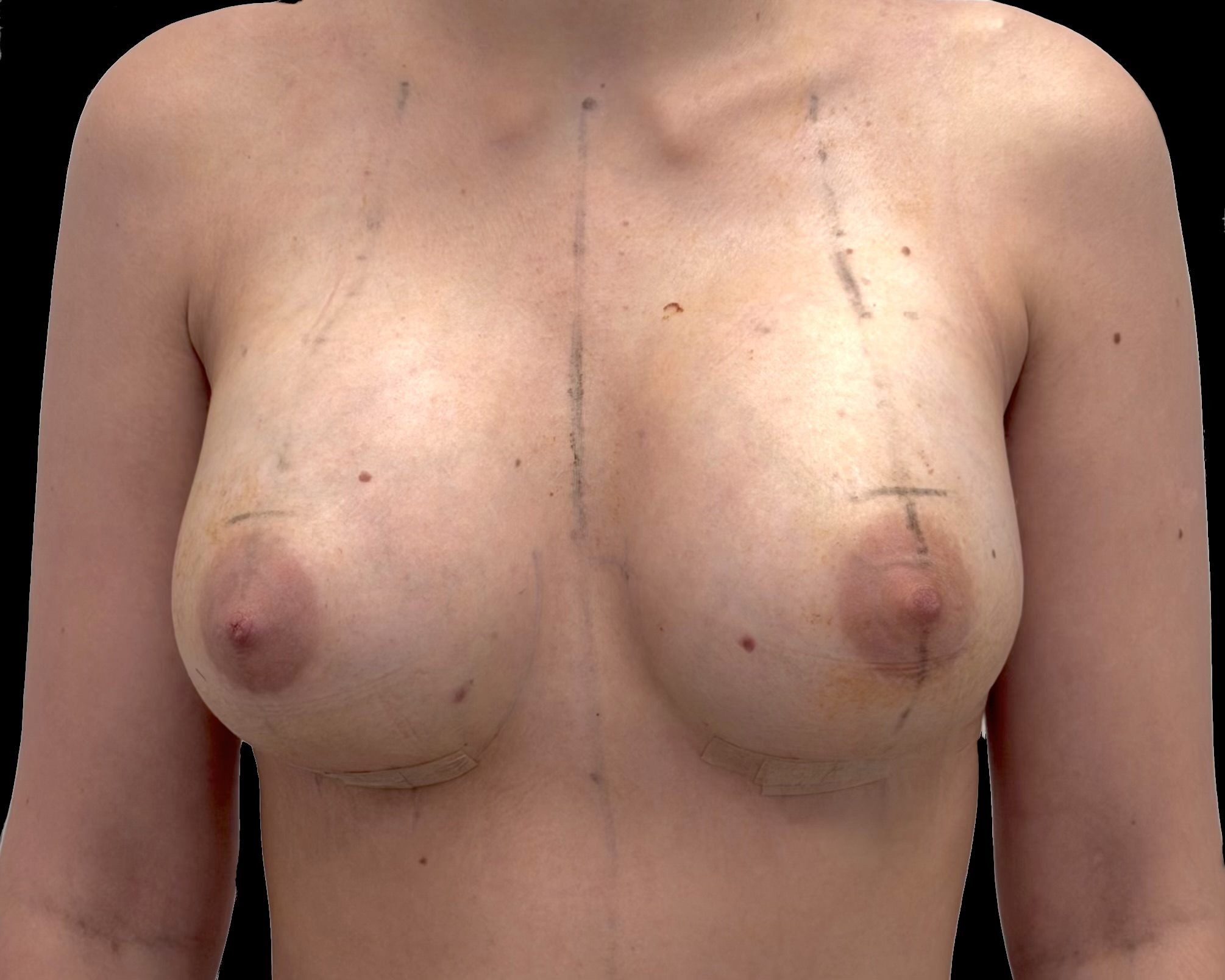 Breast Augmentation after treatment