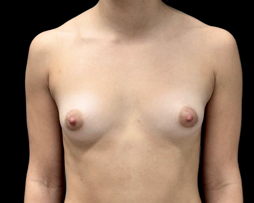 Breast Augmentation before treatment