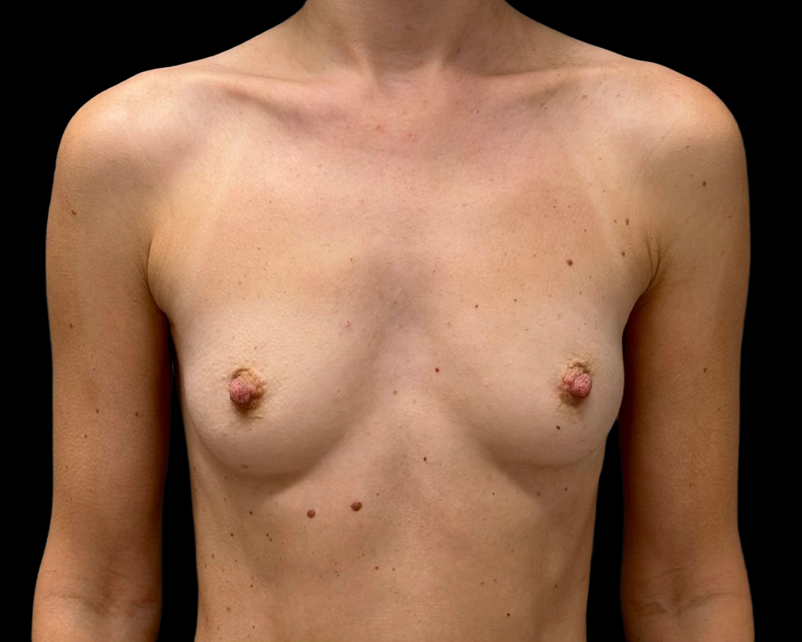 Breast Augmentation before treatment