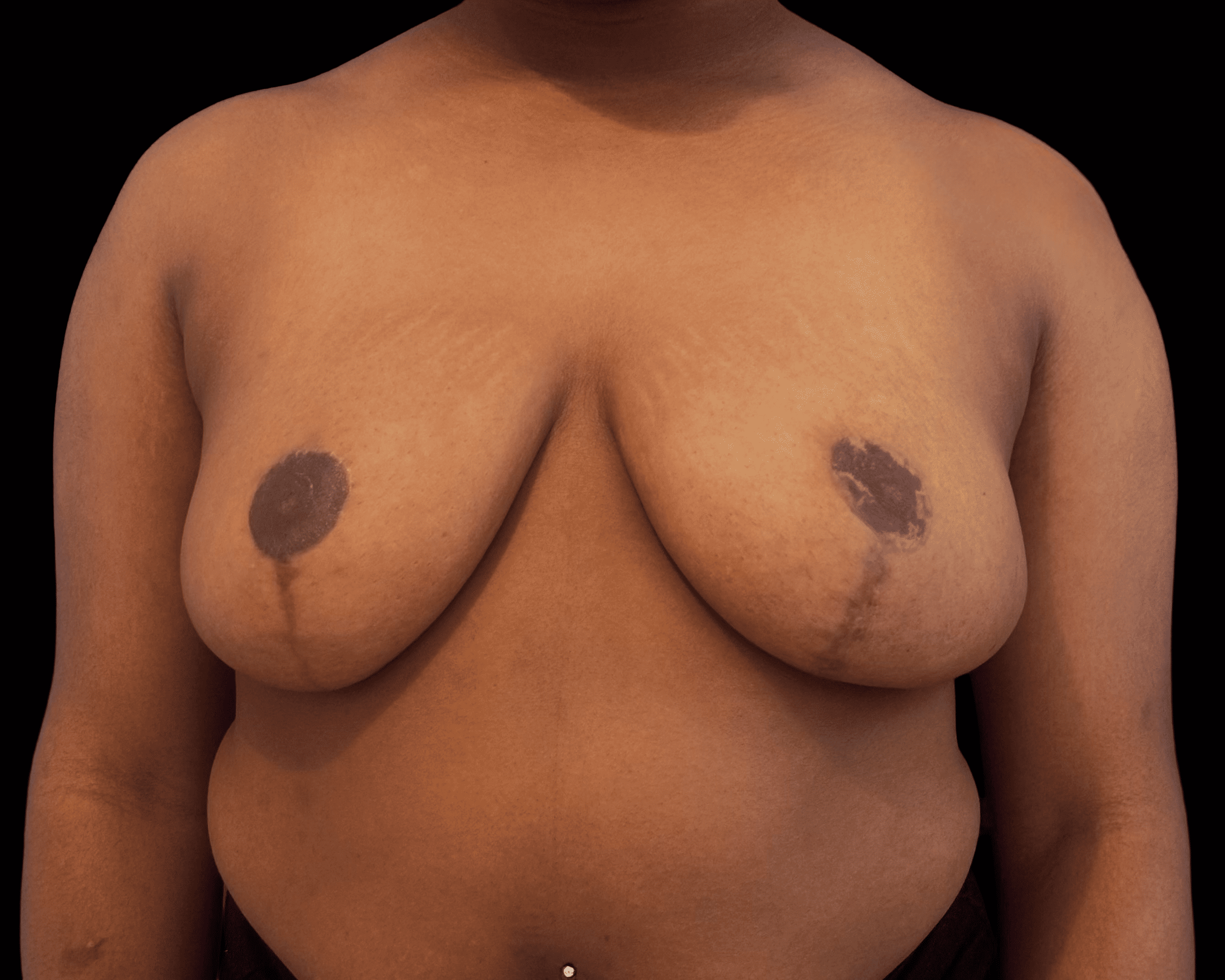 Breast Reduction after treatment
