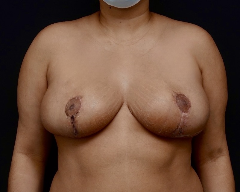 Breast Reduction after treatment