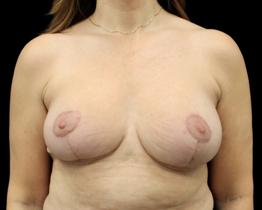 Breast Reduction after treatment