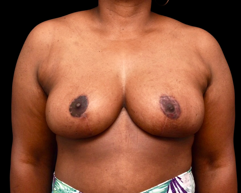 Breast Reduction after treatment