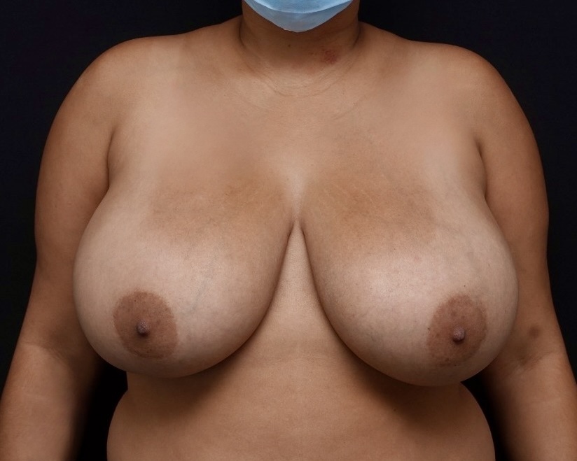 Breast Reduction before treatment