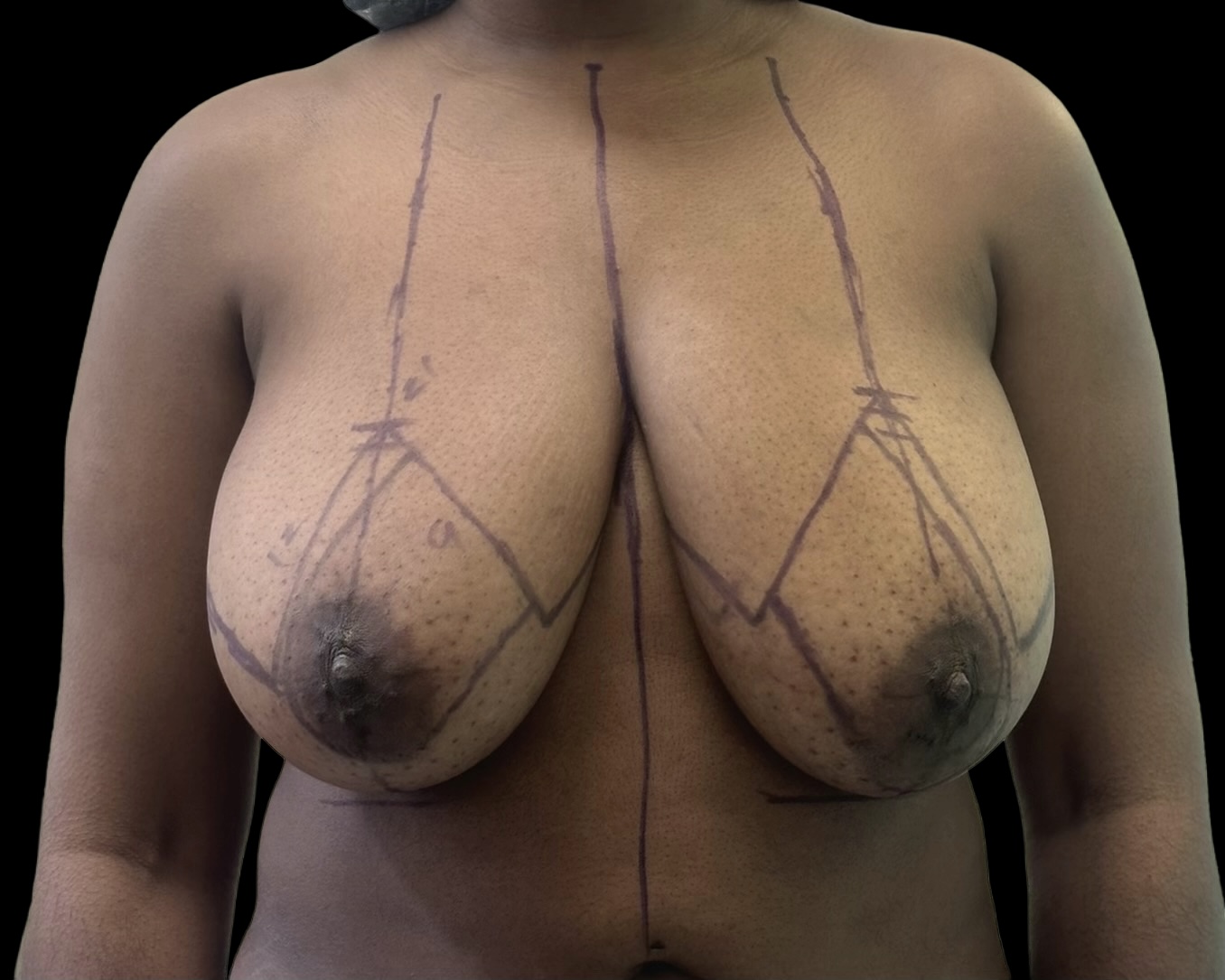 Breast Reduction before treatment