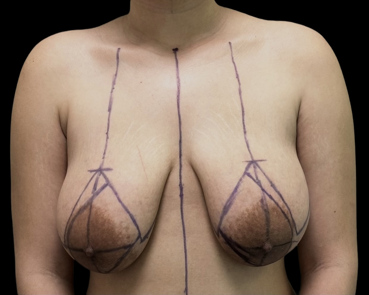 Breast Reduction before treatment