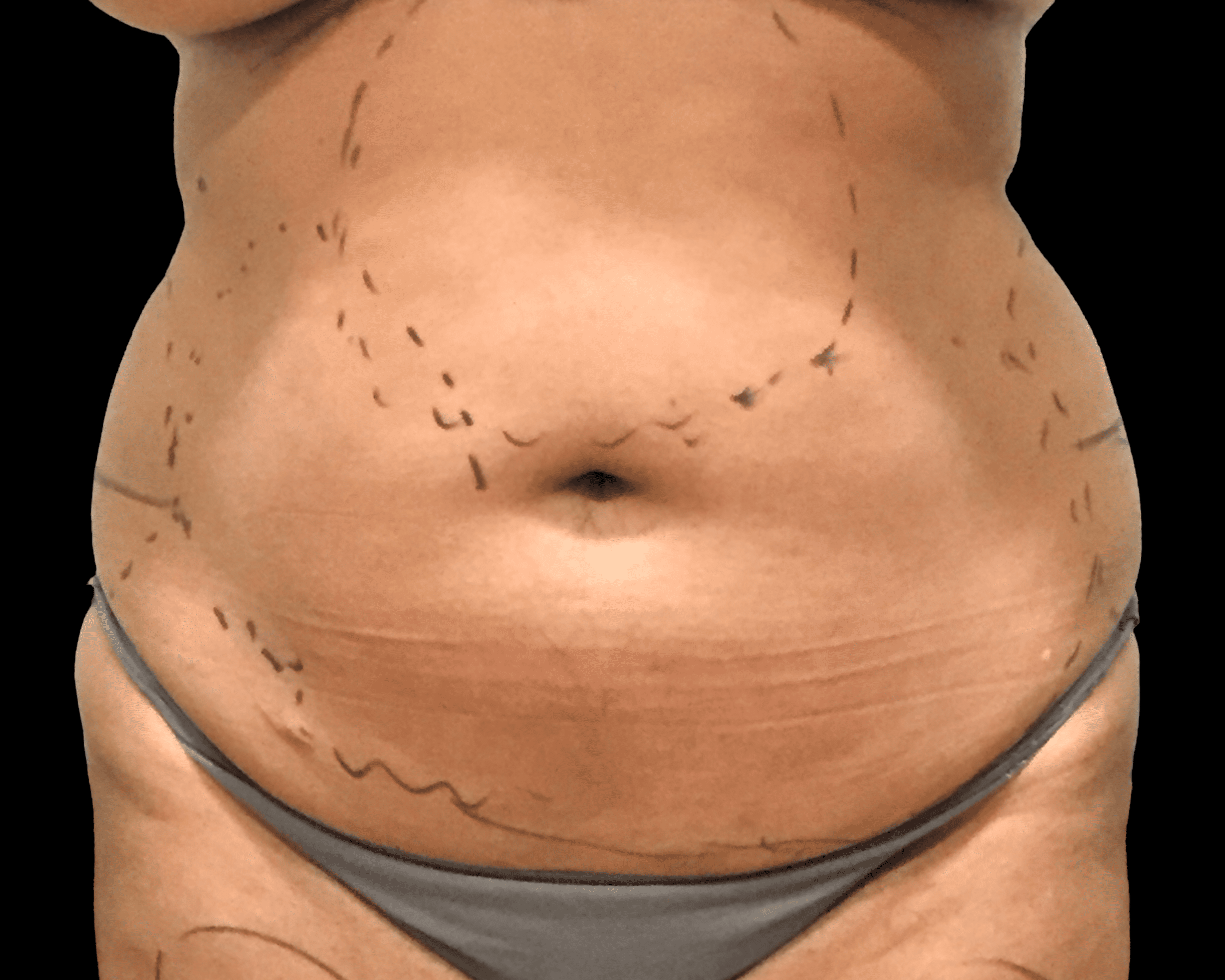 Liposuction before treatment