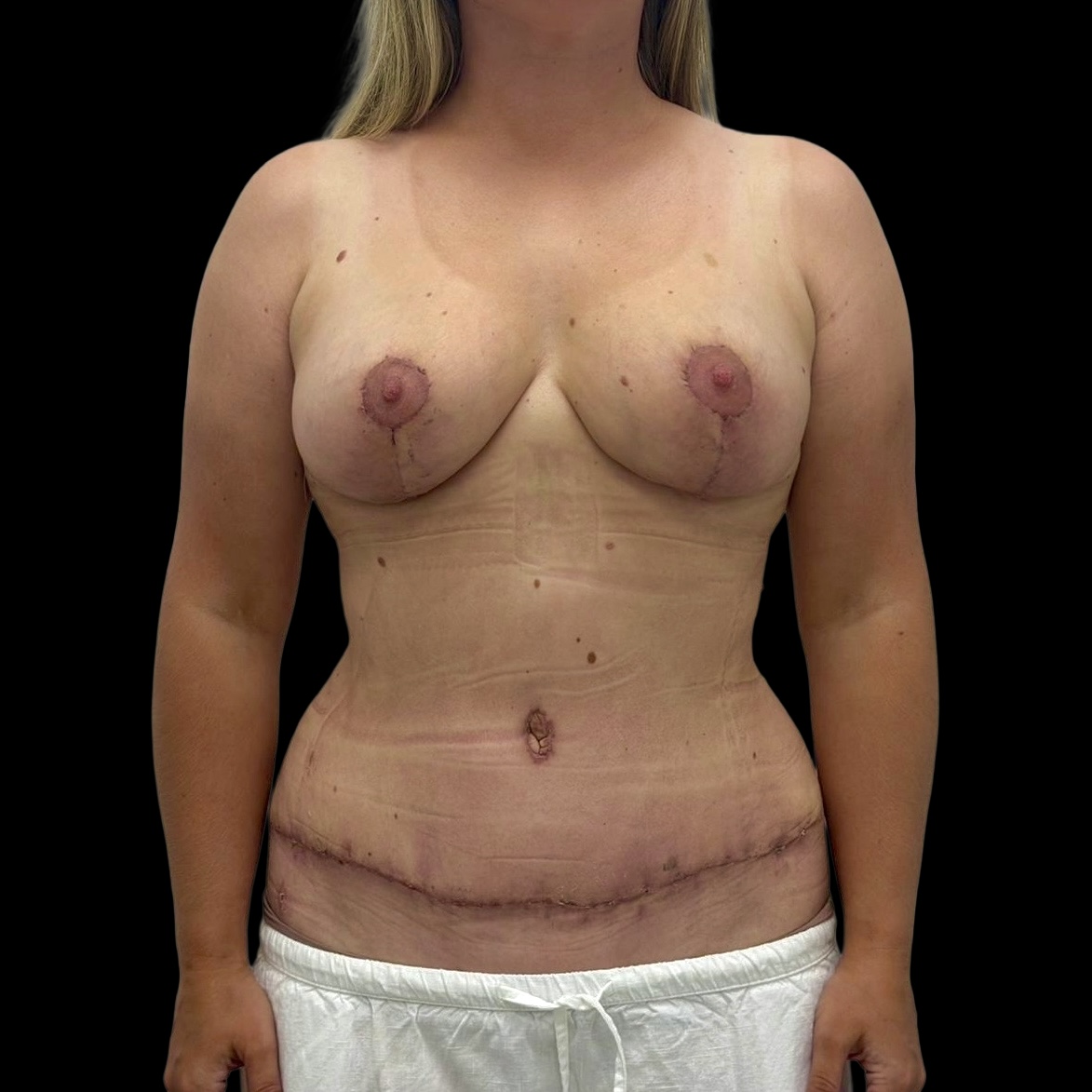 Mommy Makeover after treatment