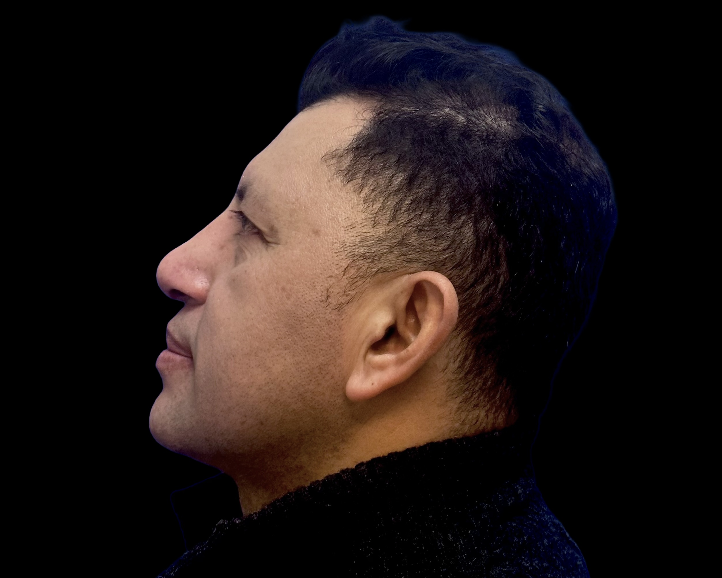 Rhinoplasty after treatment