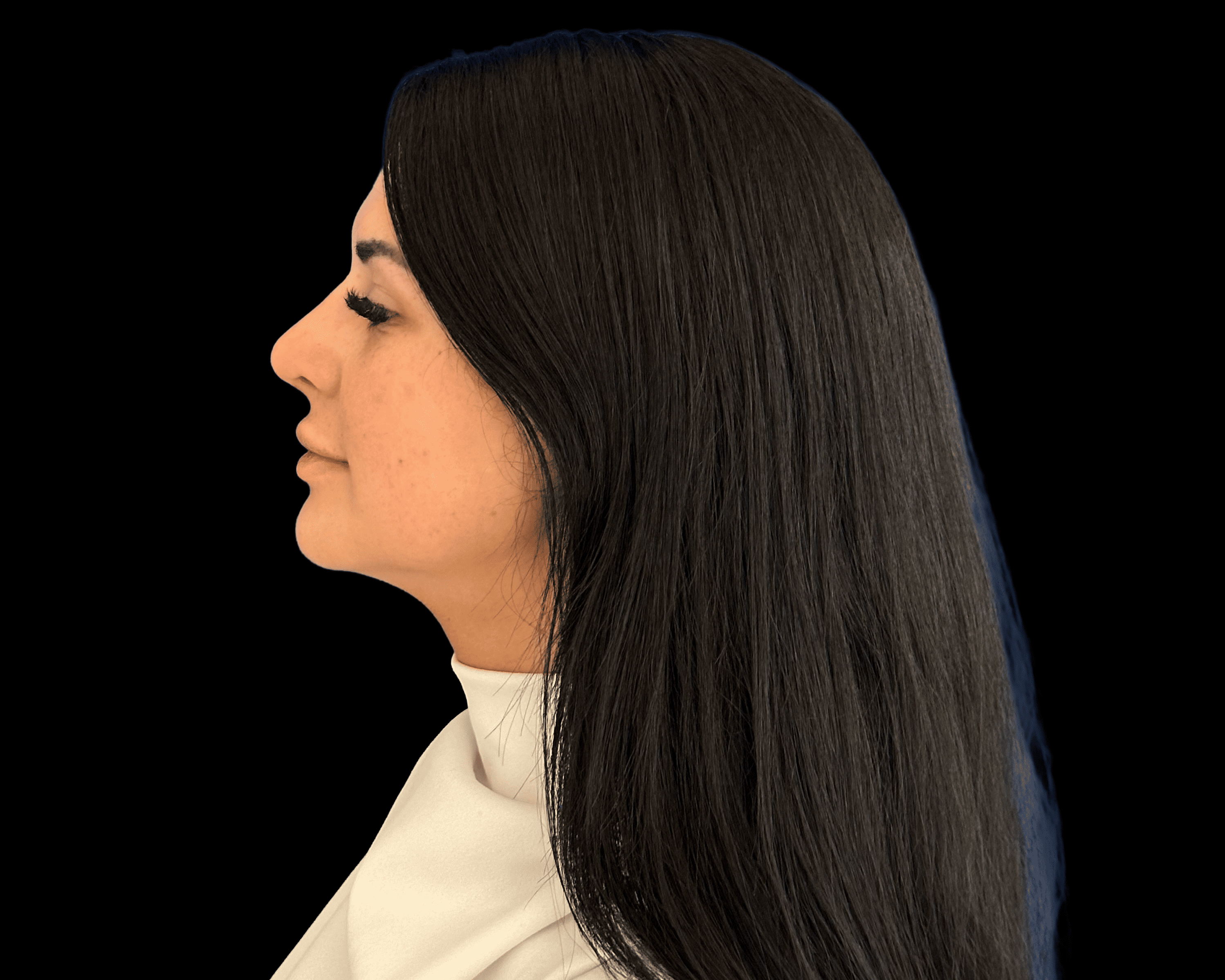 Rhinoplasty after treatment