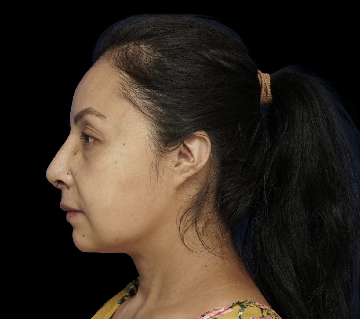 Rhinoplasty after treatment