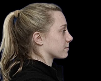 Rhinoplasty after treatment