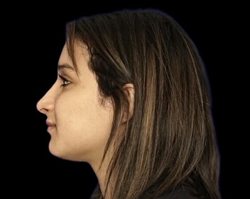 Rhinoplasty after treatment