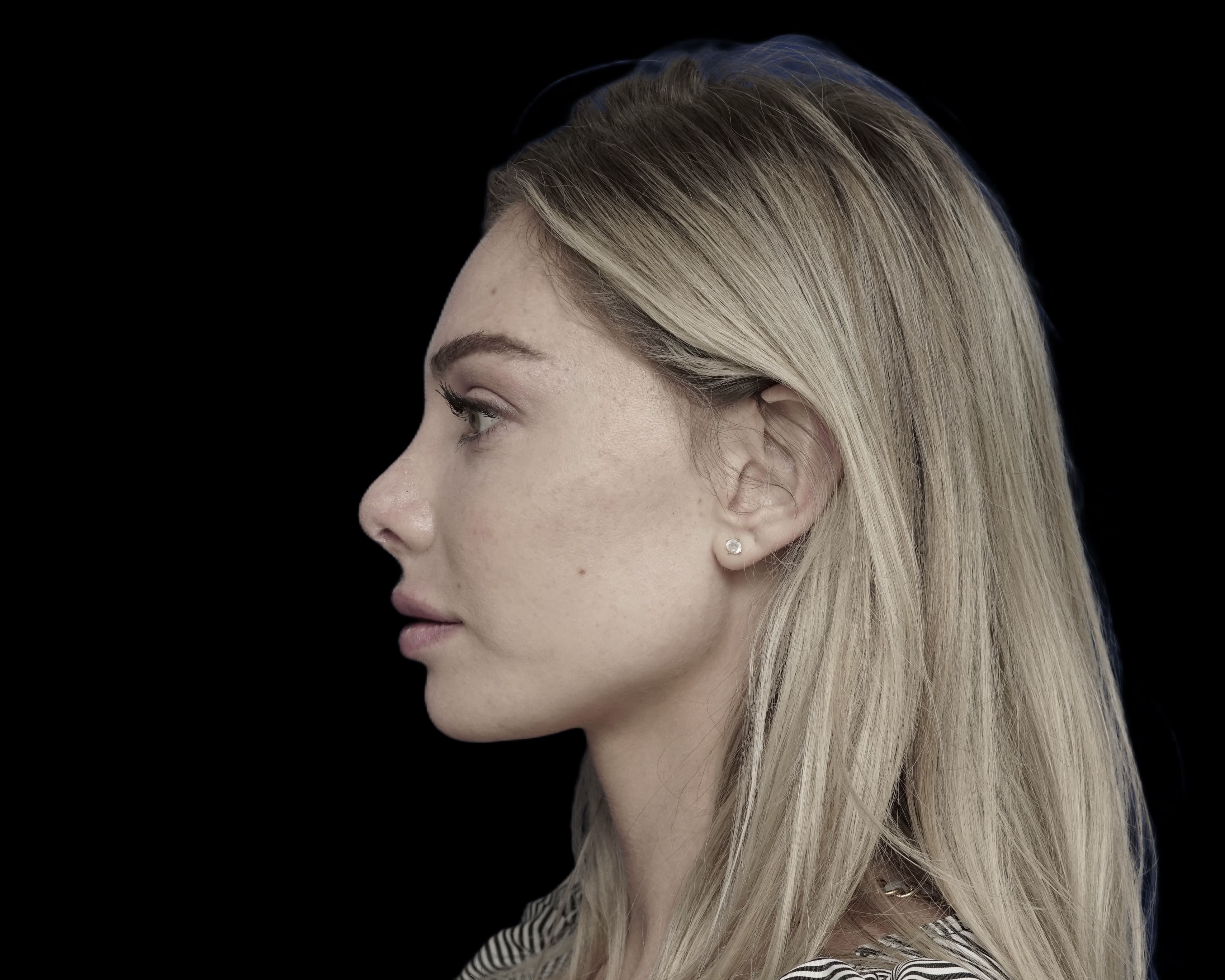 Rhinoplasty after treatment