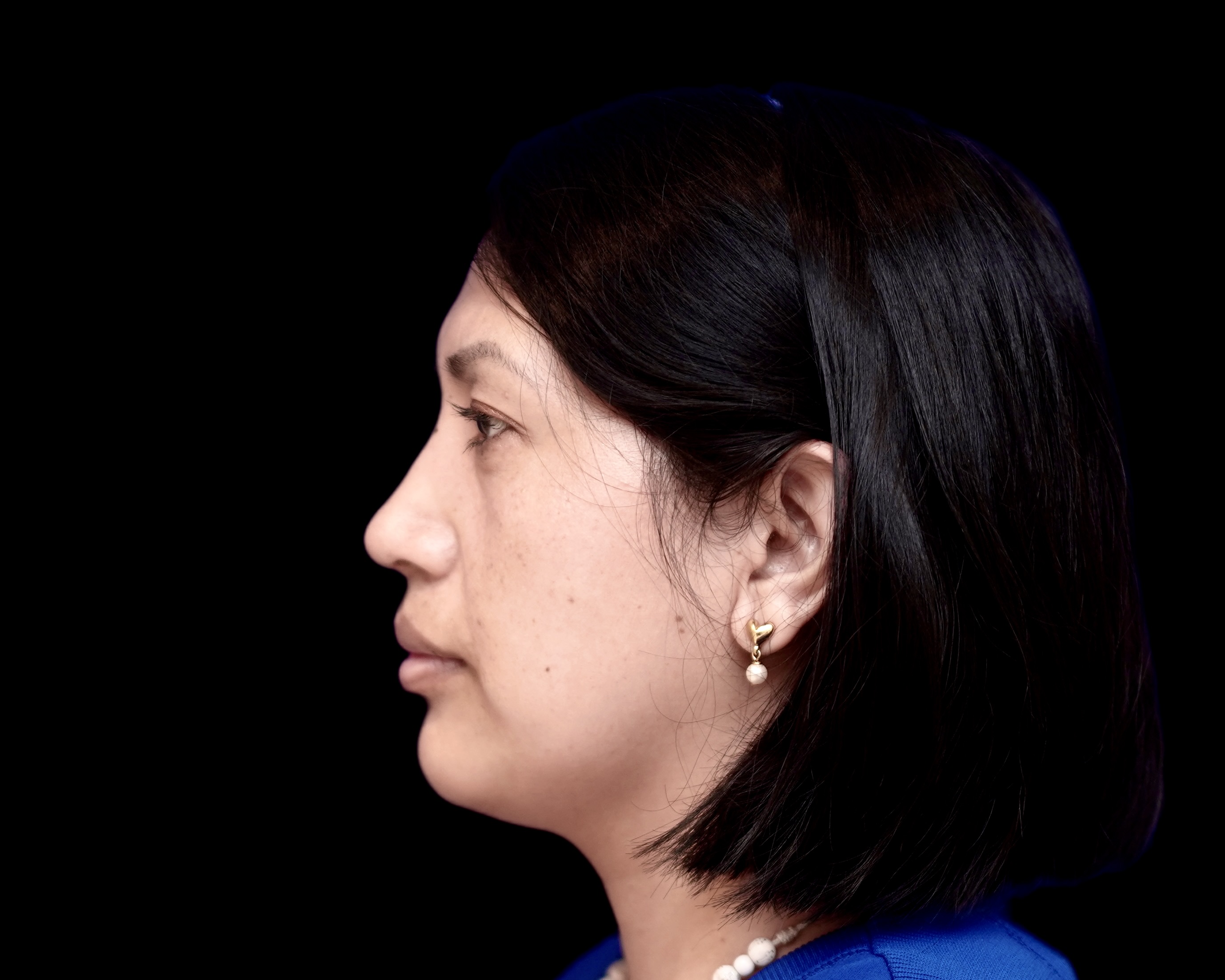 Rhinoplasty after treatment