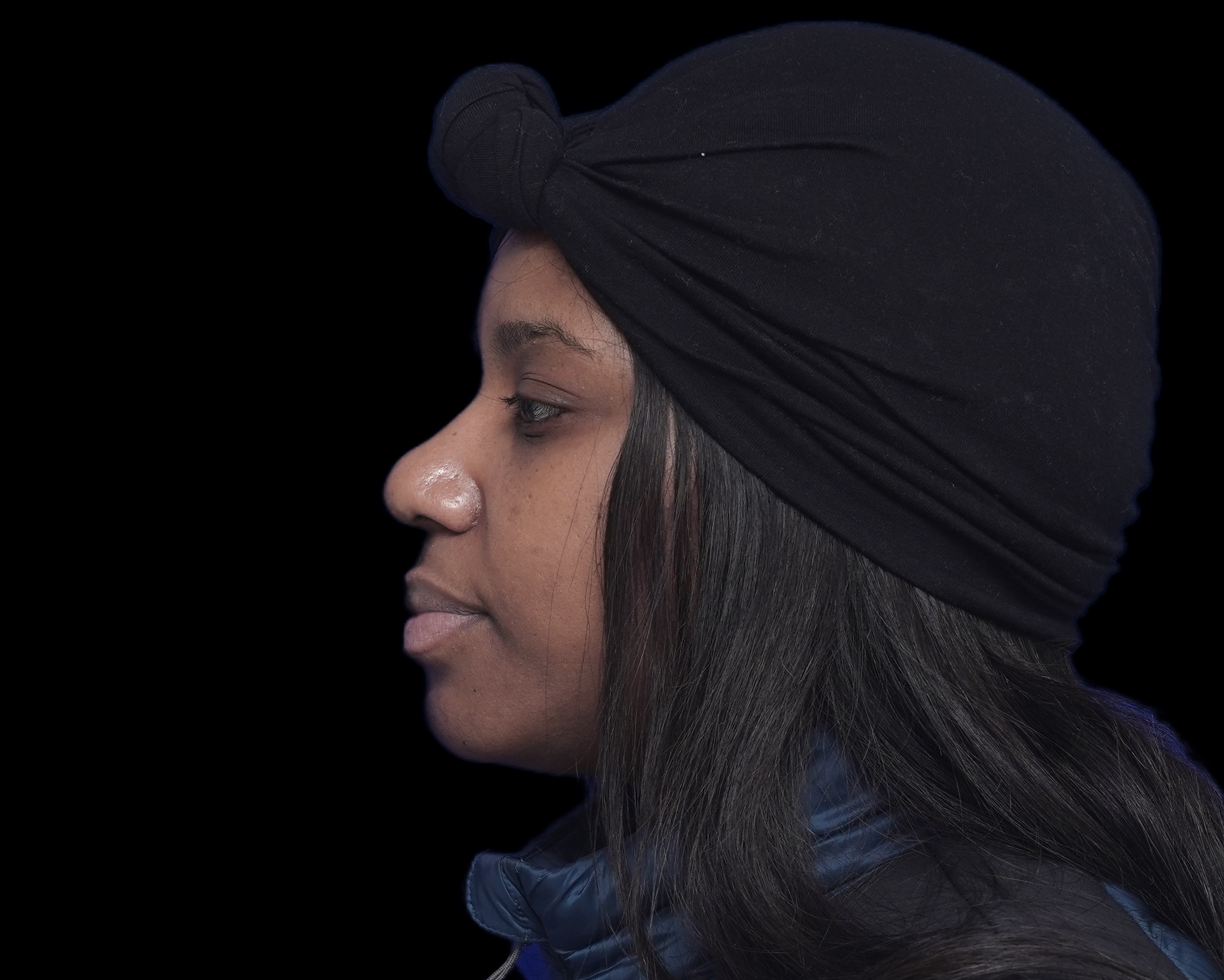 Rhinoplasty after treatment