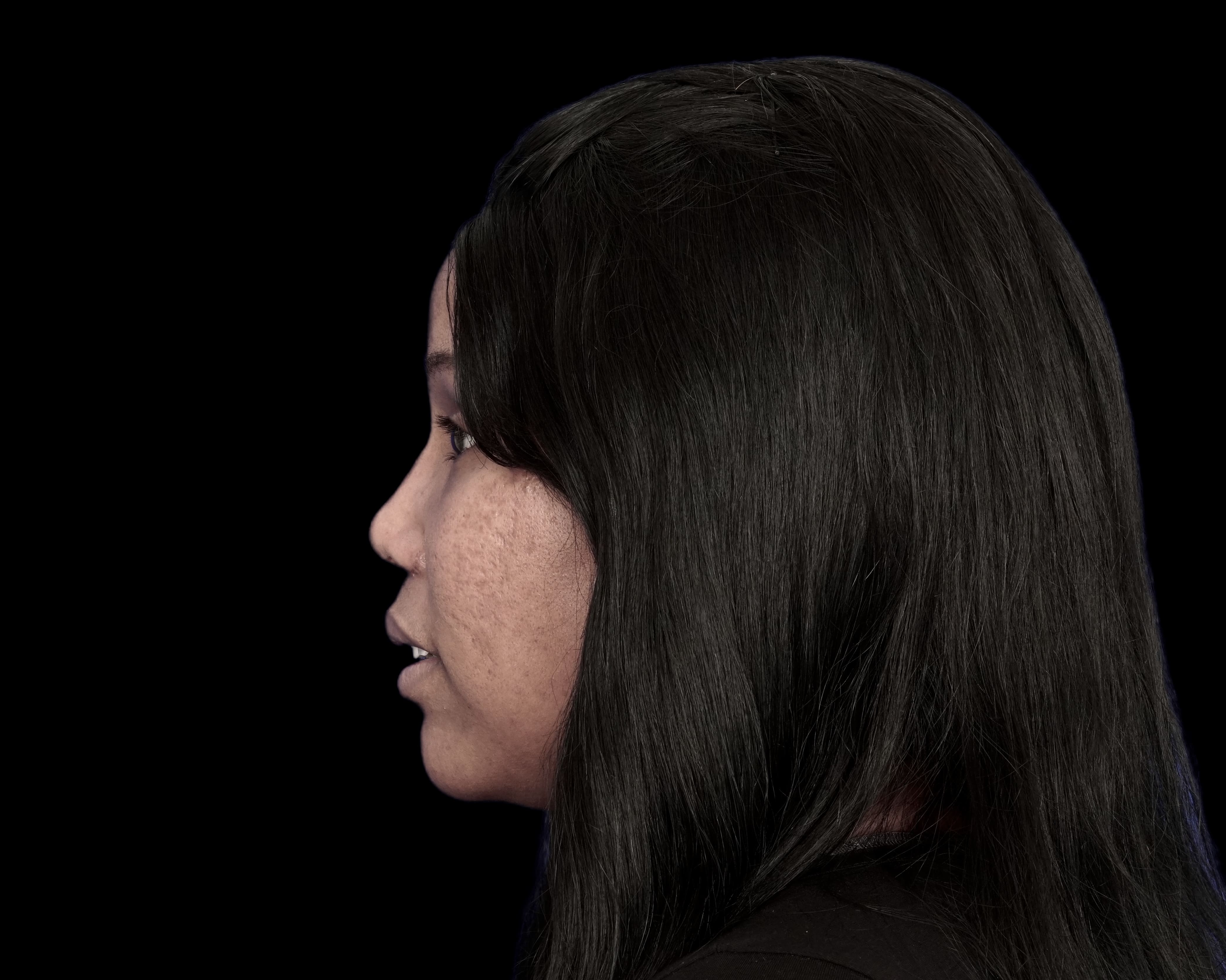 Rhinoplasty after treatment