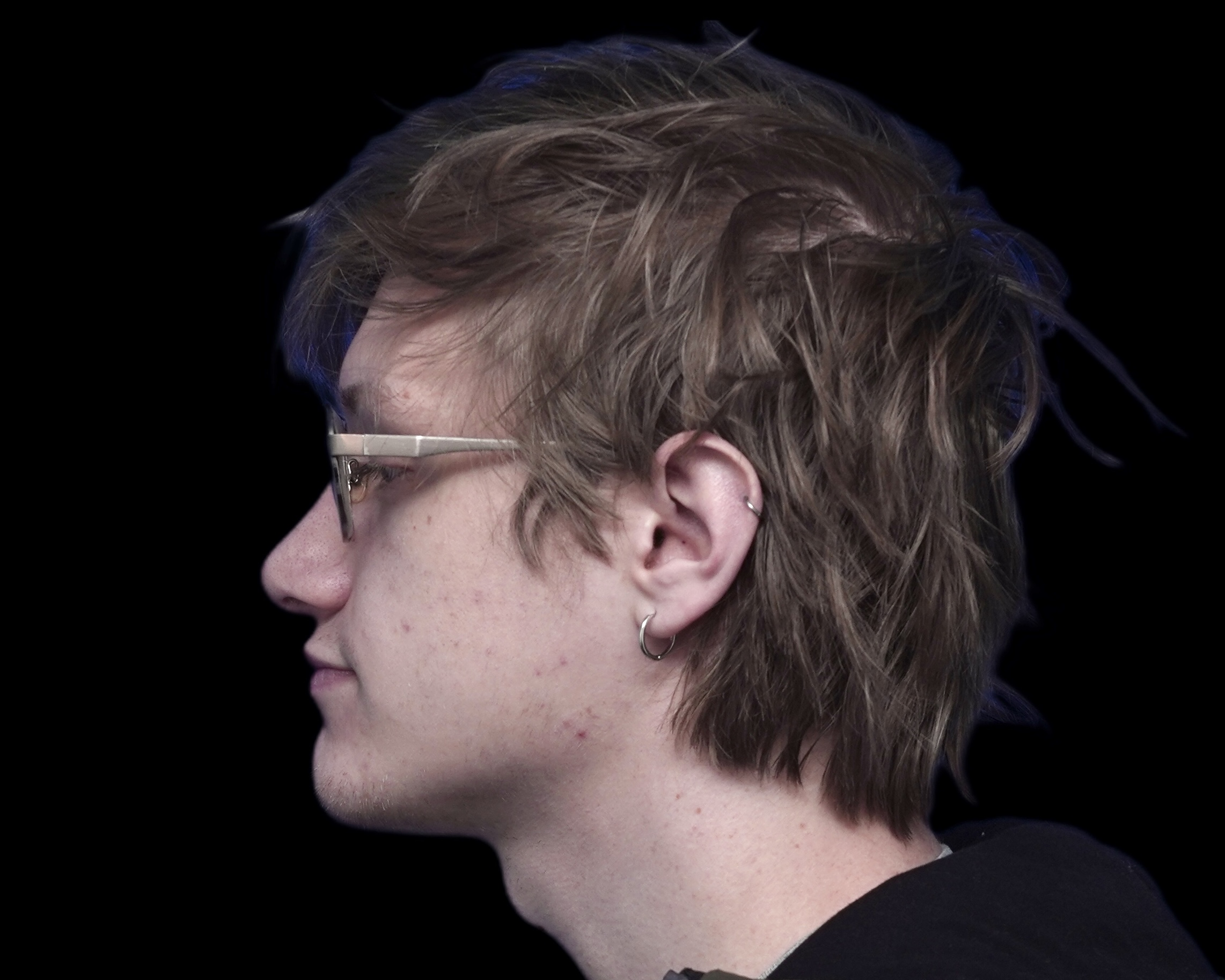Rhinoplasty after treatment
