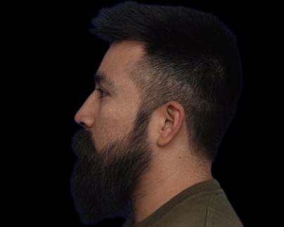Rhinoplasty after treatment