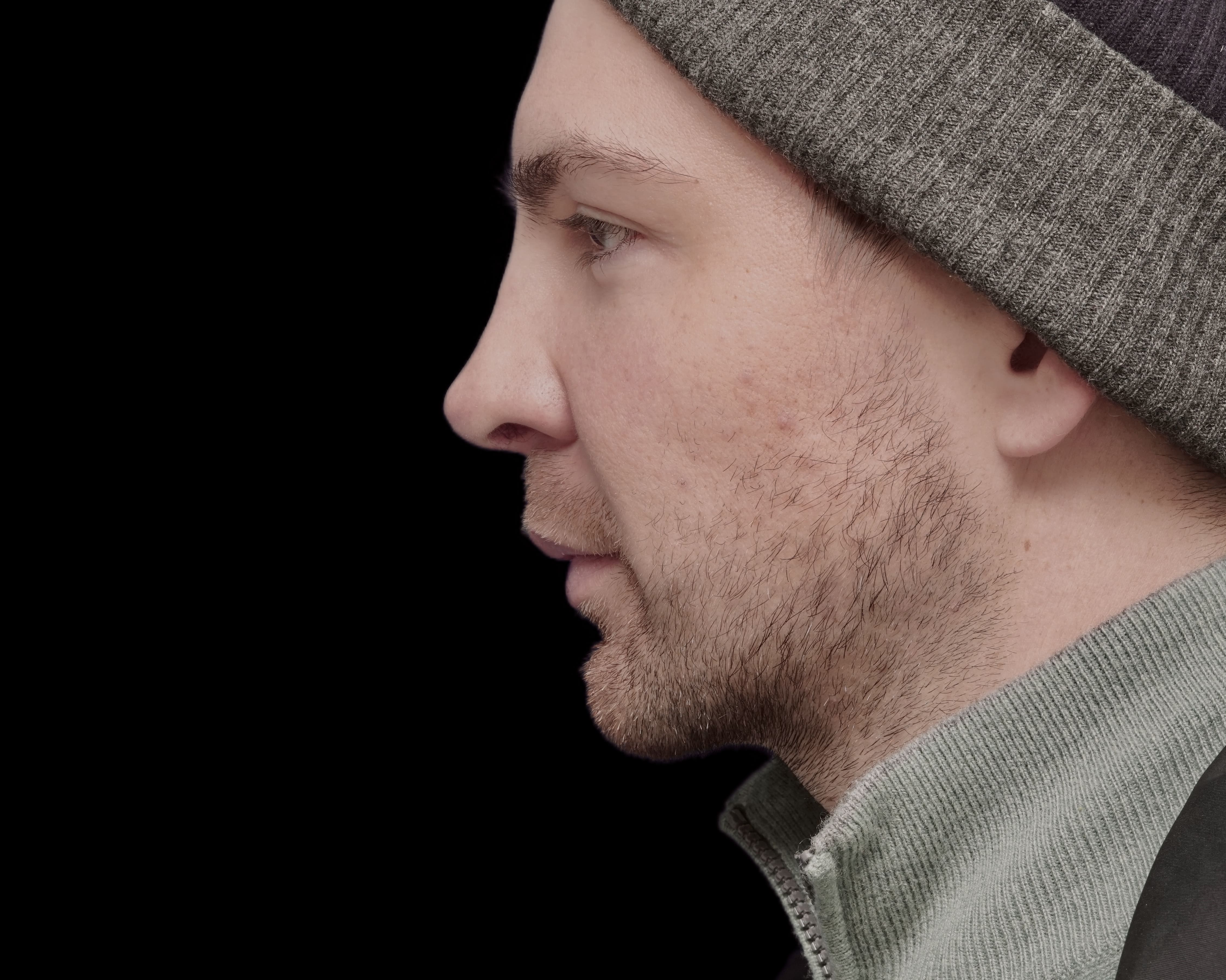 Rhinoplasty after treatment