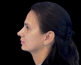 Rhinoplasty after treatment