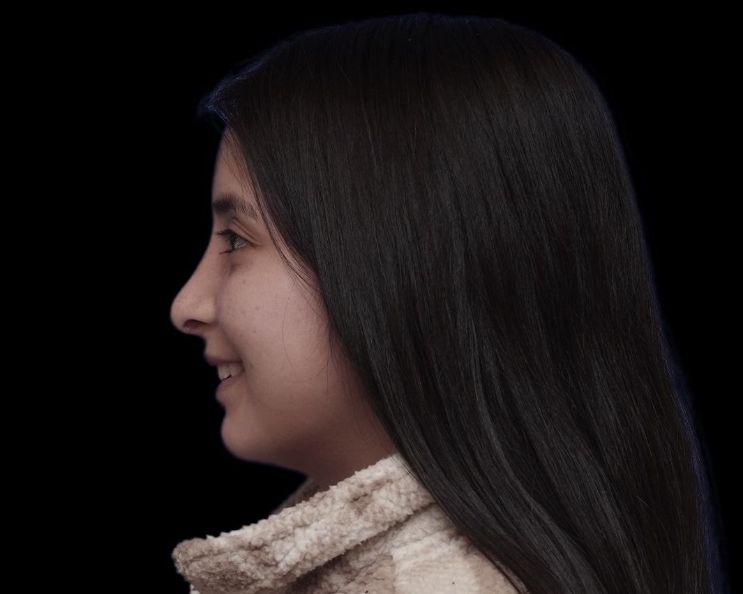 Rhinoplasty after treatment