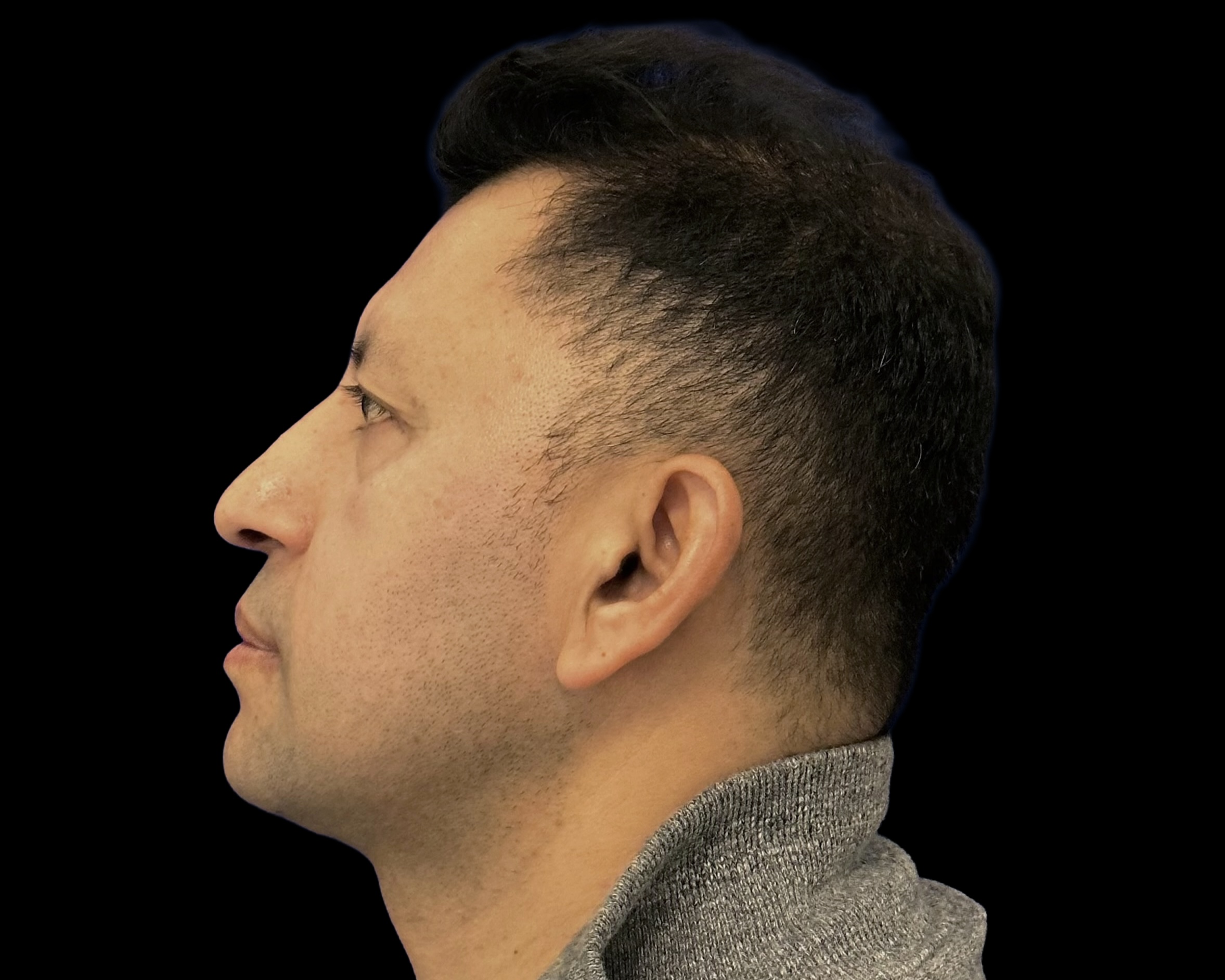 Rhinoplasty before treatment