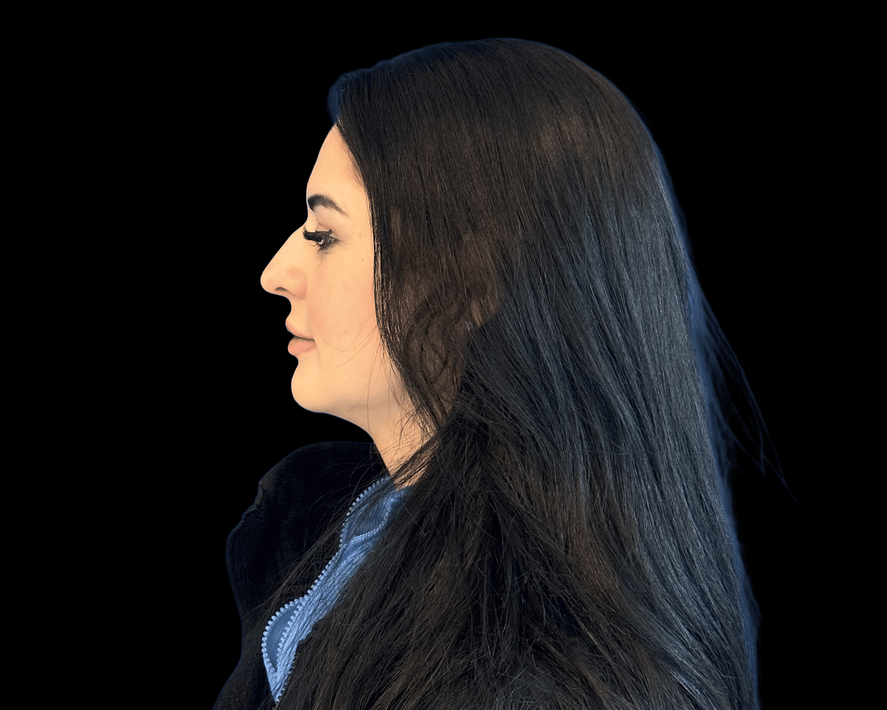 Rhinoplasty before treatment