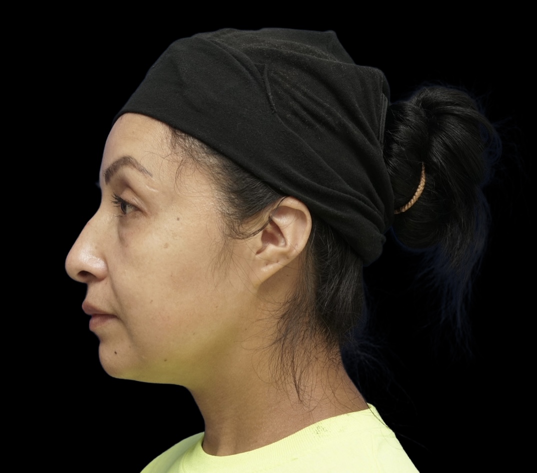 Rhinoplasty before treatment
