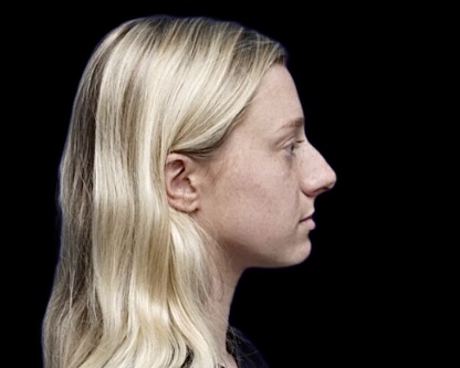 Rhinoplasty before treatment