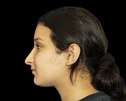 Rhinoplasty before treatment