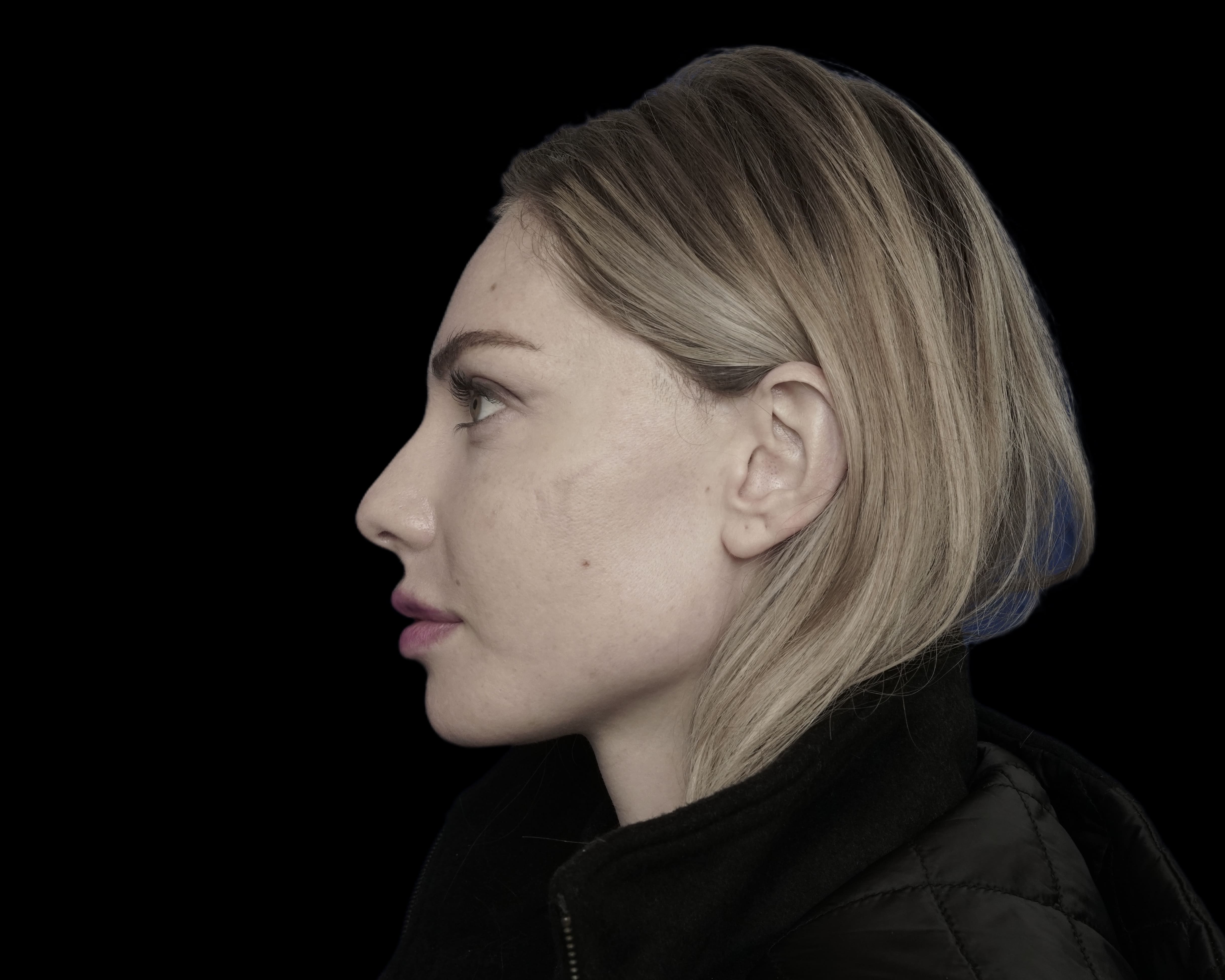Rhinoplasty before treatment