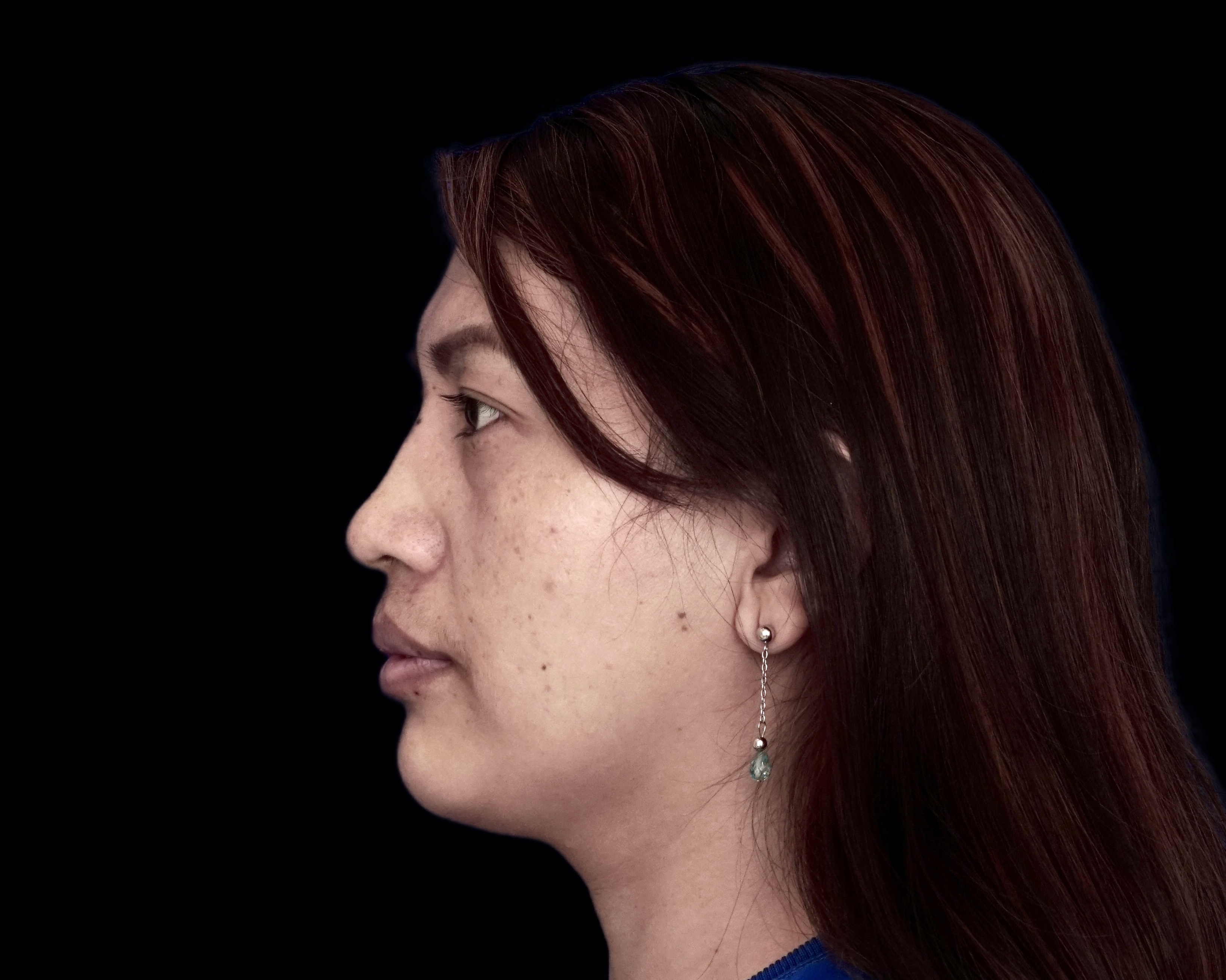 Rhinoplasty before treatment
