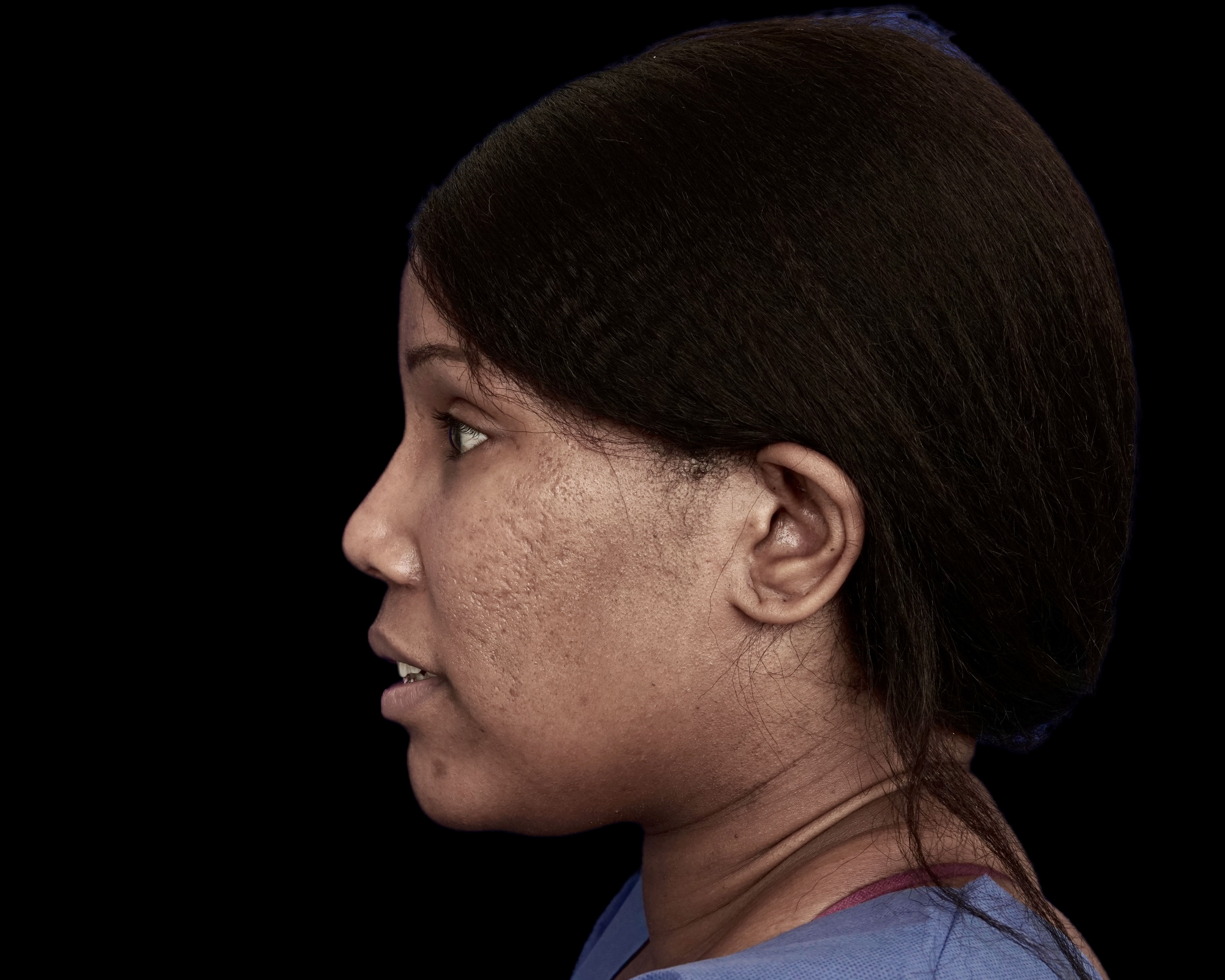 Rhinoplasty before treatment