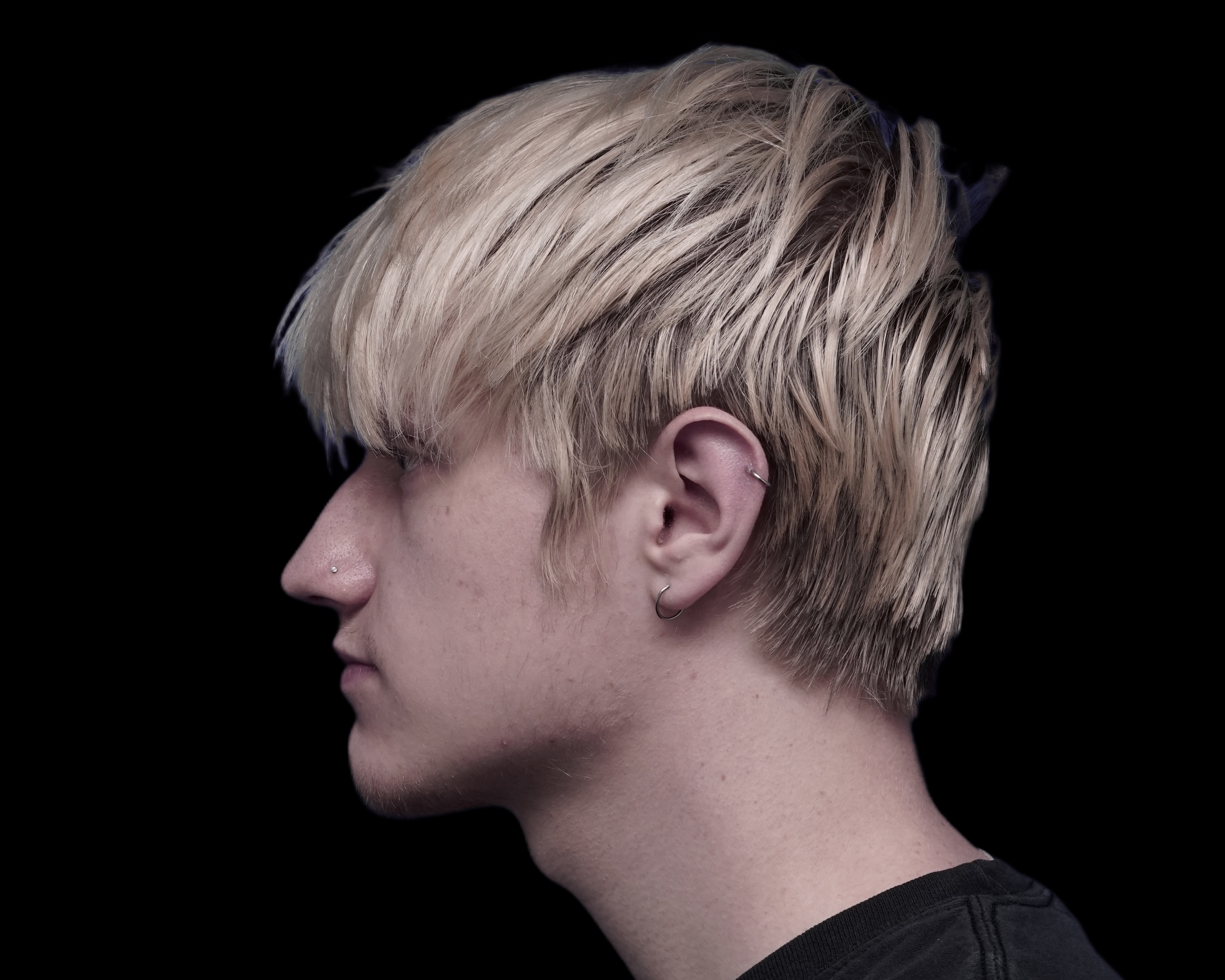 Rhinoplasty before treatment