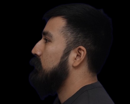 Rhinoplasty before treatment
