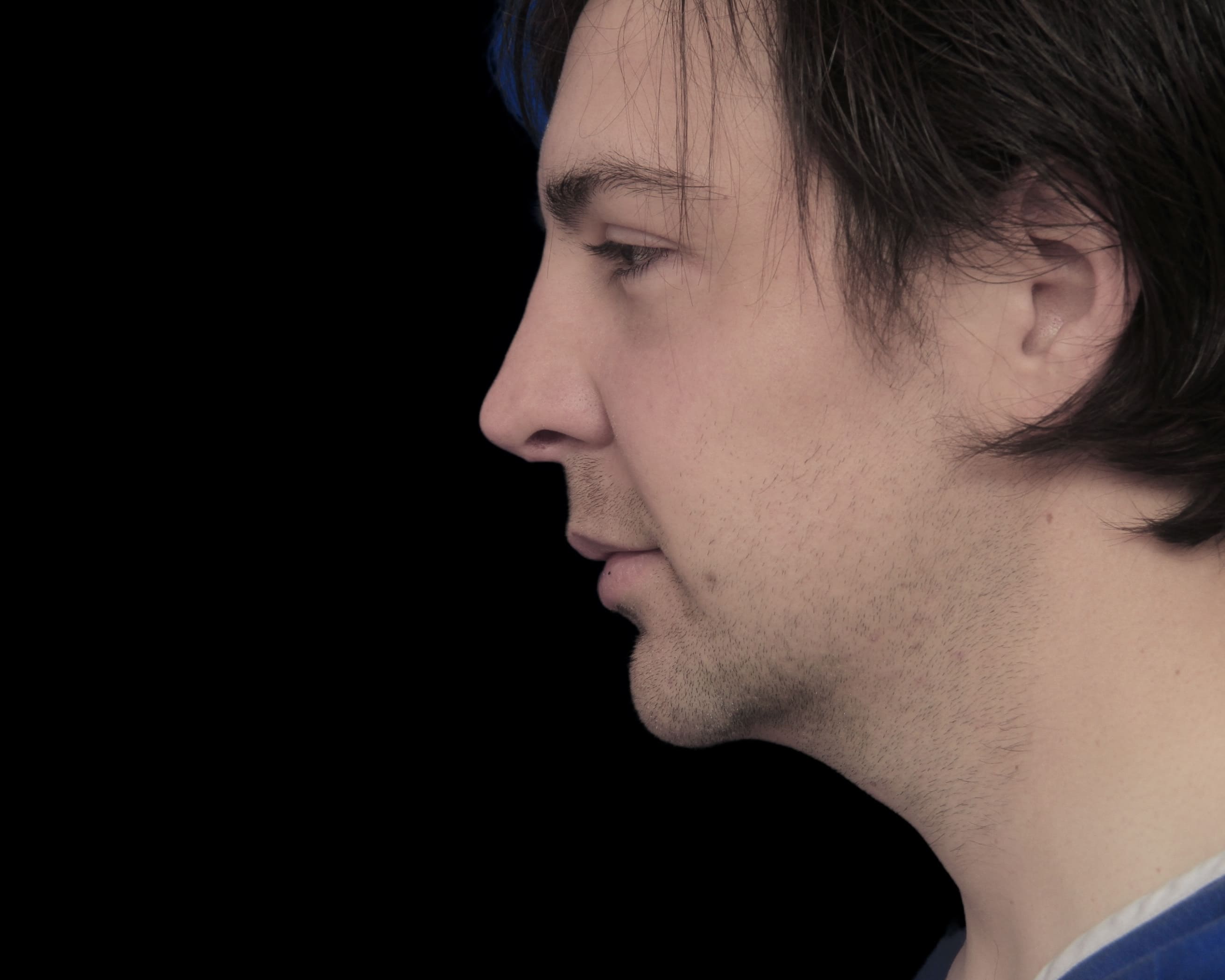 Rhinoplasty before treatment
