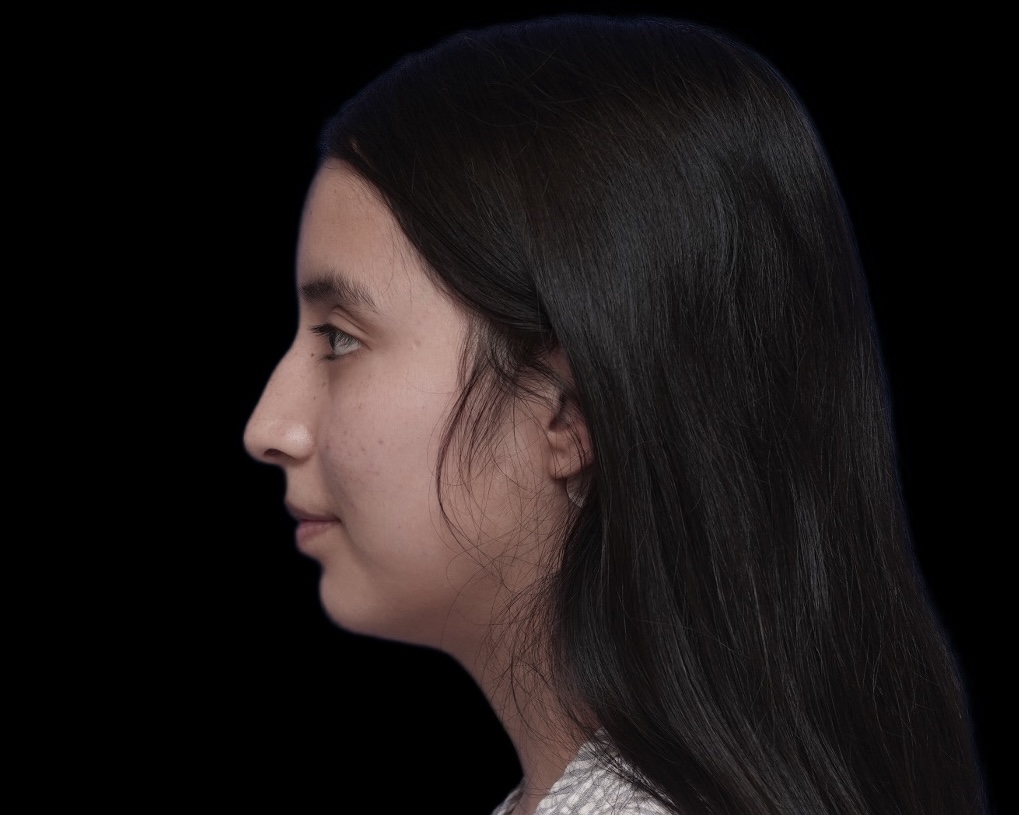 Rhinoplasty before treatment